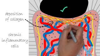 Chronic pulpitis  Diseases of pulp Part 4 [upl. by Nickola22]