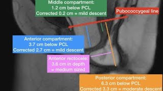 MRI Defecogram Proctogram [upl. by Suiradal32]