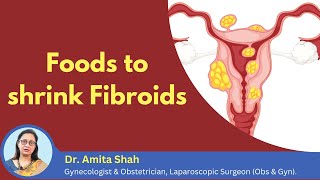 How to shrink the growth of fibroids  Fibroid shrinking foods  Dr Amita Shah [upl. by Mona576]