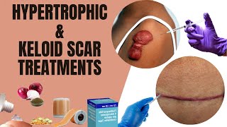 Hypertrophic amp Keloid Scar Explained  Treatment Options [upl. by Carrie]