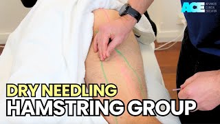 Dry Needling Hamstring Group [upl. by Milton]