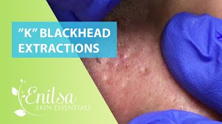 Blackheads Extractions “K’s” 3rd Treatment [upl. by Boyer]