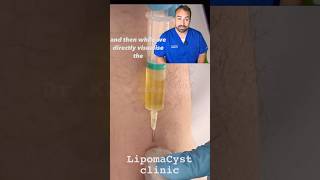 Bakers Cyst drainage under ultrasound [upl. by Frum]