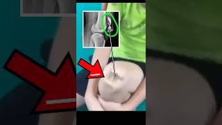 A Man BROKE his KneeCap during Tennis Here’s What Happened Next anatomy radiology medical [upl. by Novyaj]