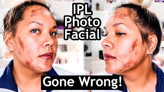 IPL Photofacial Before And After  I WONT DO THIS AGAIN [upl. by Marcus]