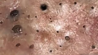 Blackheads amp Whiteheads Satisfying Removal 0084 [upl. by Barnabas355]