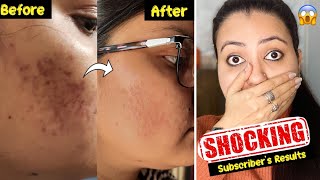 Subscribers Magical Skincare Challenge  Strongest Remedy To Remove Dark SpotsAcne Pimples Marks💕 [upl. by Elena464]