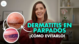 🔴 DERMATITIS en los PARPADOS ¿QUÉ ES y COMO SE CURA drapilarochoa  Dermatologa [upl. by Ihcelek326]