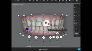 How to close upper diastema with clear aligner treatment and planning tips for Invisalign Spark [upl. by Kcinemod]