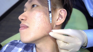 Acne Scar Keloid Steroid Injection  Dr Ho Rui Ming Singapore [upl. by Irtimd]