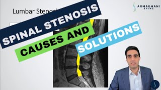 Lumbar Spinal Stenosis  What is the cause and how will I get better [upl. by Yael]