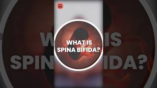 Spina Bifida ये नवजात शिशु में होने वाली बीमारी क्या है spinabifida spinabifidaawareness 1mg [upl. by Valoniah]