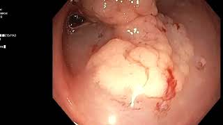 lateral spreading tumor of the colon resection by EMR [upl. by Glogau]