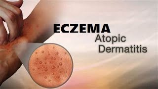 What is Eczema A Type of skin condition I Atopic Dermatitis I Allergic eczema I Neurodermatitis [upl. by Yelime]