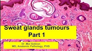 Pathology of sweat glands tumours Part 1 [upl. by Jdavie859]