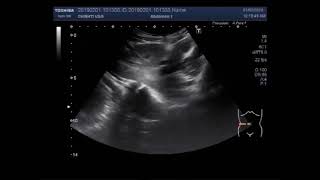 Renal Agenesis with Renal Ectopia [upl. by Atiuqihs]