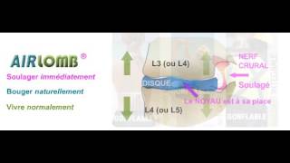 Vous souffrez de cruralgie  visualisez le soulagement quAIRLOMB vous apporterait sur vos lombaires [upl. by Akehsat361]