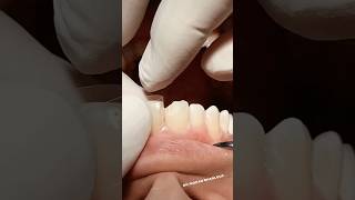 Class IV composite restoration dentist satisfying [upl. by Laehctim]