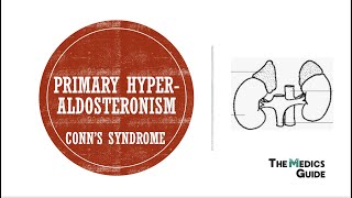 Primary Hyperaldosteronism Conns Syndrome [upl. by Juli]