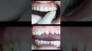 Anterior teeth Restoration  Zirconium Crown shorts dentist [upl. by Kolk]