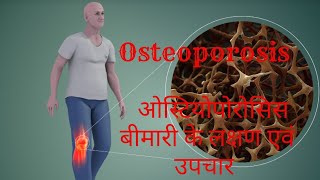 ओस्टियोपोरोसिस की बीमारी से बचाव  Osteoporosis  World Osteoporosis Day [upl. by Nirag386]