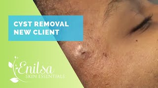 Cyst Removal New Client [upl. by Katha]