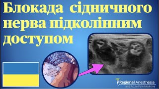 Блокада сідничного нерва підколінним доступом 🇺🇦 Popliteal Sciatic Nerve Block [upl. by Scarface]