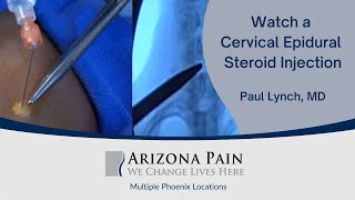 Head or Neck Pain A Cervical Epidural Steroid Injection May Help Watch it Live [upl. by Ominoreg314]