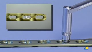 Technique  Locking Compression Plate LCP Application [upl. by Keelby]