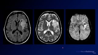 Neuroradiology Board Review  Brain Tumors  Case 17 [upl. by Aimas]