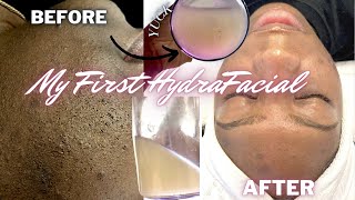 I CANT BELIEVE THAT CAME OUT MY SKIN 😱😳 My FIRST HYDRAFACIAL  ACNE PRONE SKIN EXTRACTIONS LED [upl. by Perl]