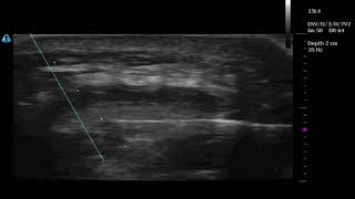 Ultrasound guided Patellar Tendon PRP injection axial [upl. by Attalanta]