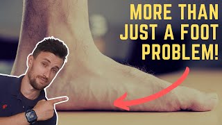 Why Flat Feet Are More Than Just a Foot Problem [upl. by Marvin]