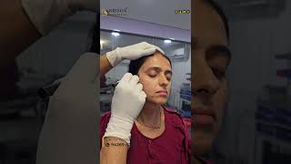 PICO Laser technology picolaser laser skincare pigmentation beauty pico fillers botox yt [upl. by Idieh614]