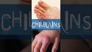 How to avoid Chilblains shorts [upl. by Lorna]