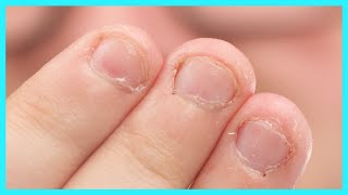 Fix Bitten Nails and Avoid Allergies with My Hack [upl. by Nowaj979]