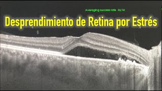 Desprendimiento de retina por estrés [upl. by Airret]