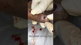 subungual hematoma تجمع دموي تحت الاصبع [upl. by Carlynne]