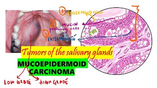 Mucoepidermoid carcinoma Histopathology  Clinical features  DETAILED  BDS NEET MDS [upl. by Randy]