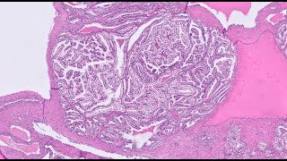 Clear cell papillary renal cell tumor CCPRCT  highyield educational video for AP boards [upl. by Eikcaj]