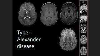 How to think about Diagnosis in the Leukodystrophies in 2020 [upl. by Kreiker]