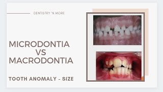 DEVELOPMENTAL DISTURBANCES OF TEETH  PART 1SIZE [upl. by Koball]