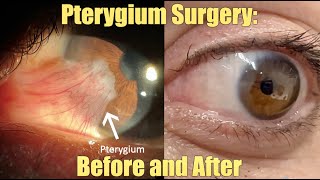 Ptergyium Surgery  Before and After What is it How we remove it Recovery and Results [upl. by Macnamara]