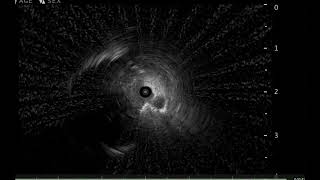 Cone beam CT guided Biopsy [upl. by Aisyle]