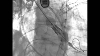 TAVRTranscatheter Aortic Valve Replacement Transaortic Deployment [upl. by Attenna933]