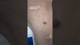 Skin Tag Removal Results 🤩 skintagremoval [upl. by Navac]