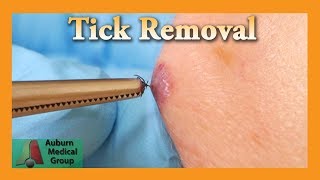 Dead Tick Removal  Auburn Medical Group [upl. by Yerffe]