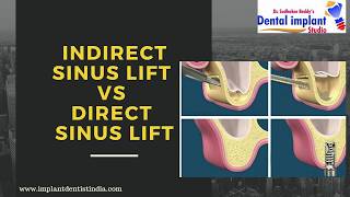 Indirect sinus lift vs Direct sinus lift [upl. by Tuddor]