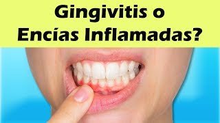 COMO CURAR LA GINGIVITIS Remedios Caseros Para La Gingivitis y Encías Inflamadas [upl. by Enyalaj784]