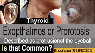 Exopthalmos or Prorotosis  Described as protrusion of the eyeball [upl. by Bo]